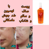 لوسیون ضدجوش و کنترل کننده چربی