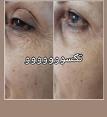 کرم سه کاره دور چشم