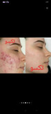 کرم ضدجوش و کنترل کننده چربی صورت ماسکانی