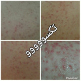 کرم ضدجوش و کنترل کننده چربی صورت ماسکانی