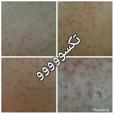 کرم ضدجوش و کنترل کننده چربی صورت ماسکانی