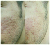 کرم ضدجوش و کنترل کننده چربی صورت ماسکانی