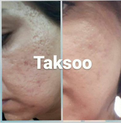 کرم ضدجوش و کنترل کننده چربی صورت ماسکانی