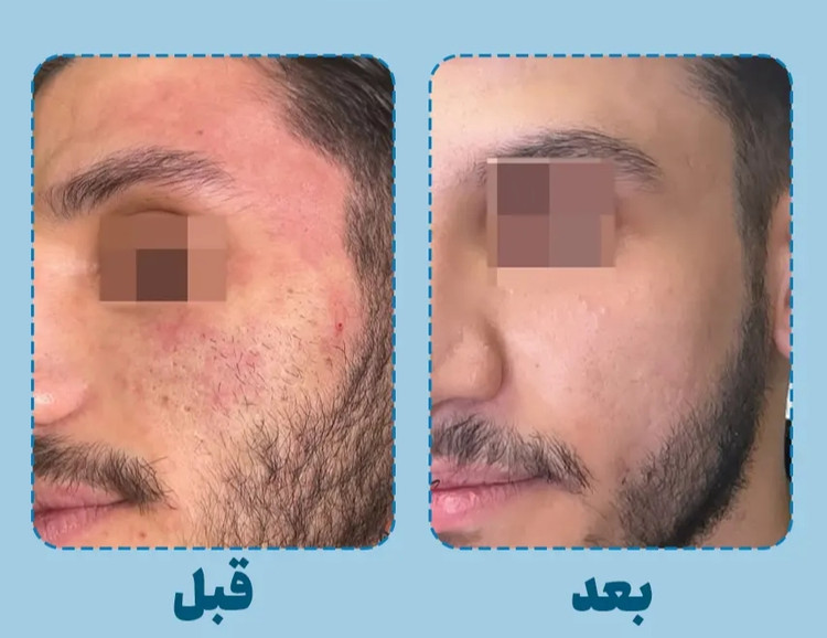 کرم جوانساز Q10 ماسکانی