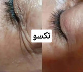 کرم دور چشم سه کاره ماسکانی