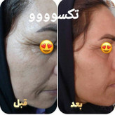 کرم دور چشم سه کاره ماسکانی