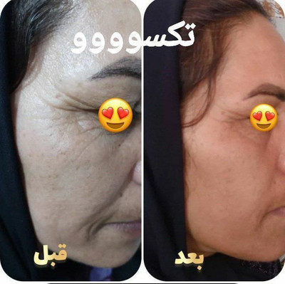 کرم دور چشم سه کاره ماسکانی