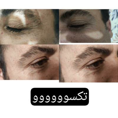 کرم دور چشم سه کاره ماسکانی