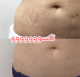 پکیج رفع ترک شکم و زبری دست و پا ماسکانی