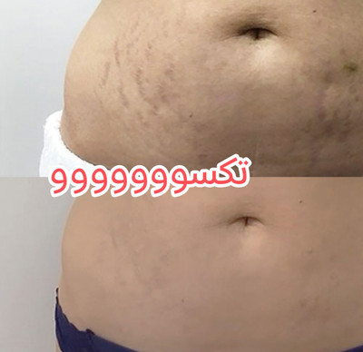 پکیج رفع ترک شکم و زبری دست و پا ماسکانی