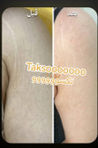 پکیج رفع ترک شکم و زبری دست و پا ماسکانی
