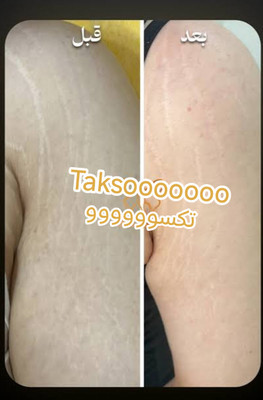 پکیج رفع ترک شکم و زبری دست و پا ماسکانی