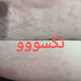 پکیج رفع ترک شکم و زبری دست و پا ماسکانی