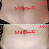 پکیج رفع ترک شکم و زبری دست و پا ماسکانی