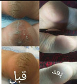 پکیج رفع ترک شکم و زبری دست و پا ماسکانی
