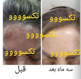 پکیج کامل ضدلک vip ماسکانی