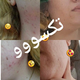 محلول پاک کننده و لوسیون ضدجوش و کنترل کننده چربی صورت ماسکانی