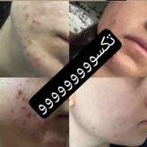 محلول پاک کننده و لوسیون ضدجوش و کنترل کننده چربی صورت ماسکانی