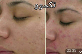 محلول پاک کننده و لوسیون ضدجوش و کنترل کننده چربی صورت ماسکانی