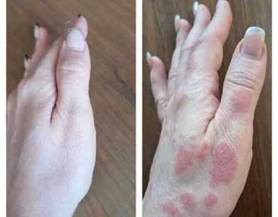 پکیج طلایی اگزما و قرمزی پوست ماسکانی،هازن و تکسو