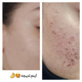 لوسیون ضدجوش و کنترل کننده چربی صورت ماسکانی