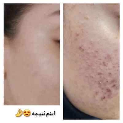 لوسیون ضدجوش و کنترل کننده چربی صورت ماسکانی