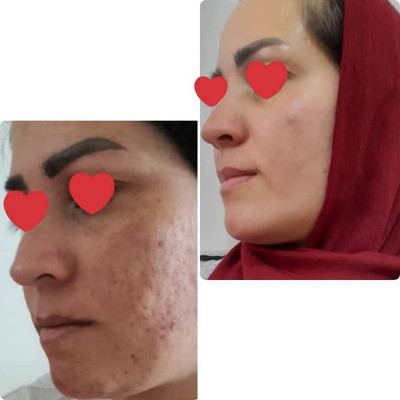 لوسیون ضدجوش و کنترل کننده چربی صورت ماسکانی