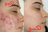 لوسیون ضدجوش و کنترل کننده چربی صورت ماسکانی