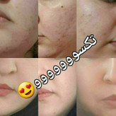 لوسیون ضدجوش و کنترل کننده چربی صورت ماسکانی