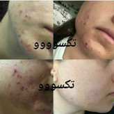 لوسیون ضدجوش و کنترل کننده چربی صورت ماسکانی