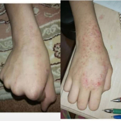 پکیج یاقوت اگزما و قرمزی پوست ماسکانی،هازن