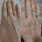 پکیج کامل اگزما و قرمزی پوست ماسکانی،تکسو و آفرینش
