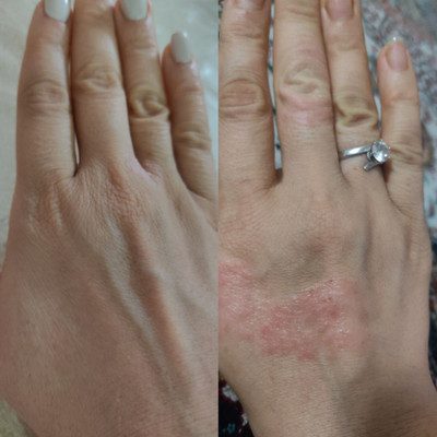 پکیج کامل اگزما و قرمزی پوست ماسکانی،تکسو و آفرینش