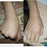 پکیج کامل اگزما و قرمزی پوست ماسکانی،تکسو و آفرینش