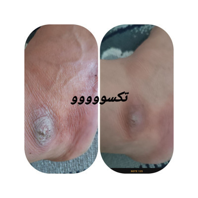 پکیج کامل اگزما و قرمزی پوست ماسکانی،تکسو و آفرینش
