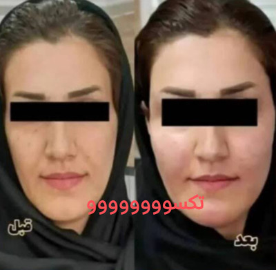 پکیج نقره ای چاقی صورت ماسکانی،تکسو