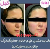 پکیج نقره ای چاقی صورت ماسکانی،تکسو