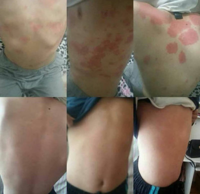 پکیج نقره ای اگزما و قرمزی پوست ماسکانی،هازن