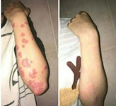 پکیج نقره ای اگزما و قرمزی پوست ماسکانی،هازن
