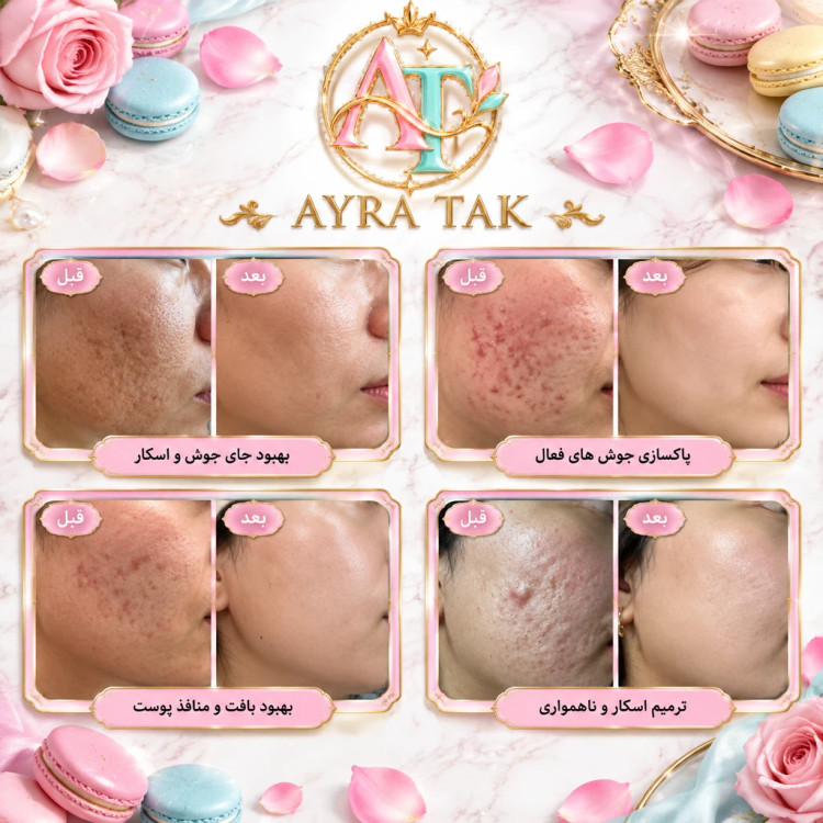 🌸پکیج تخصصی پاکسازی عمیق و کنترل چربی ماسکانی🌸