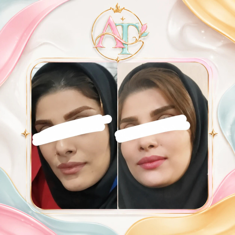 🌸 پکیج طلایی حجم دهی و پرکننده صورت🌸