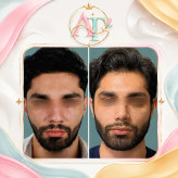 🌸 پکیج طلایی حجم دهی و پرکننده صورت🌸